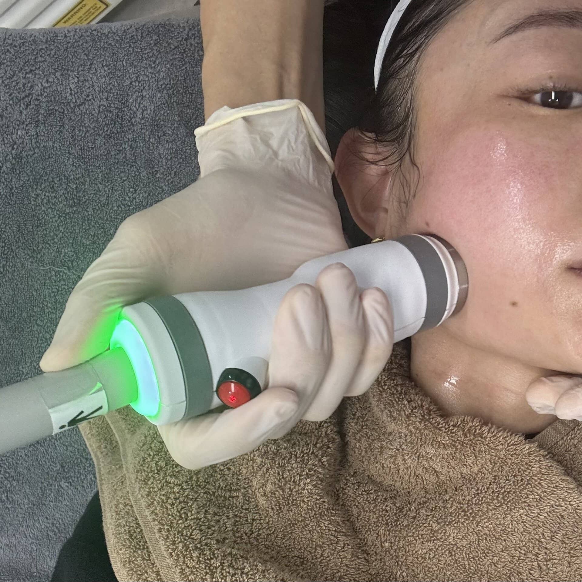 ダウンタイムなし！レーザーで行う「オンダリフティング」の【韓国在住
