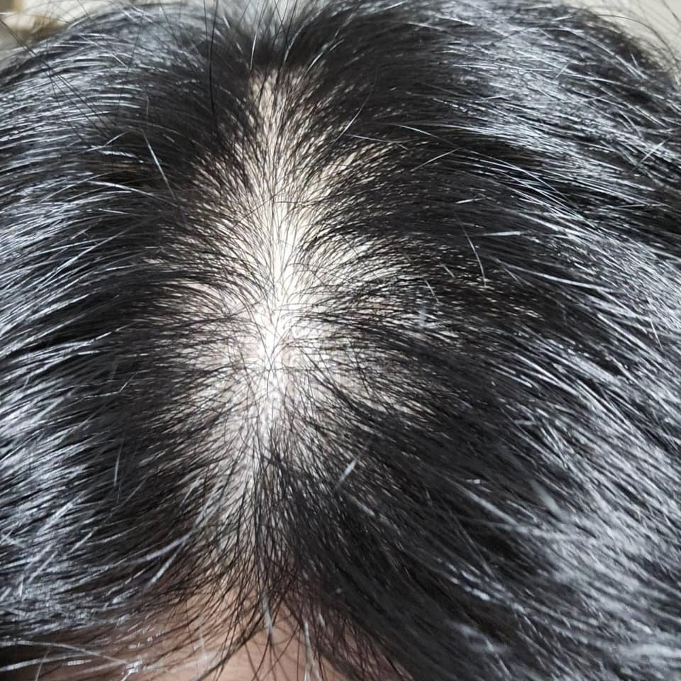 抜け毛に悩む40代が、ステラボーテのLLLTレーザー&EMSブラシで育毛に挑戦！【9カ月体験レポート】