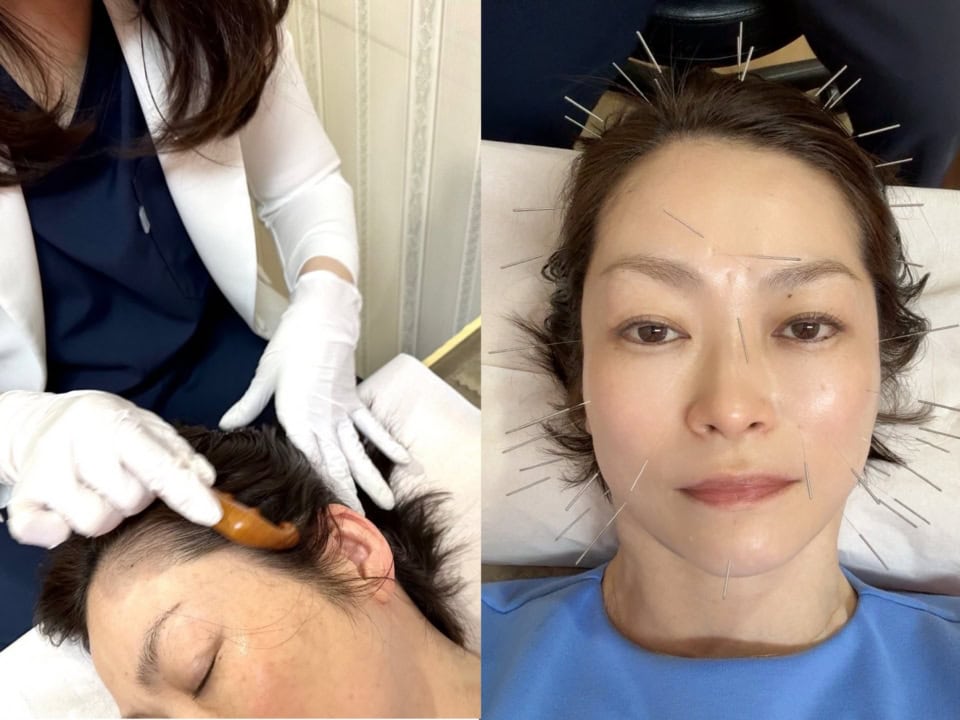 ROSY編集長・梅田がレポート！ お肌トーン爆上げ【韓国・大邱の美容ツアー】②　韓方美顔鍼編
