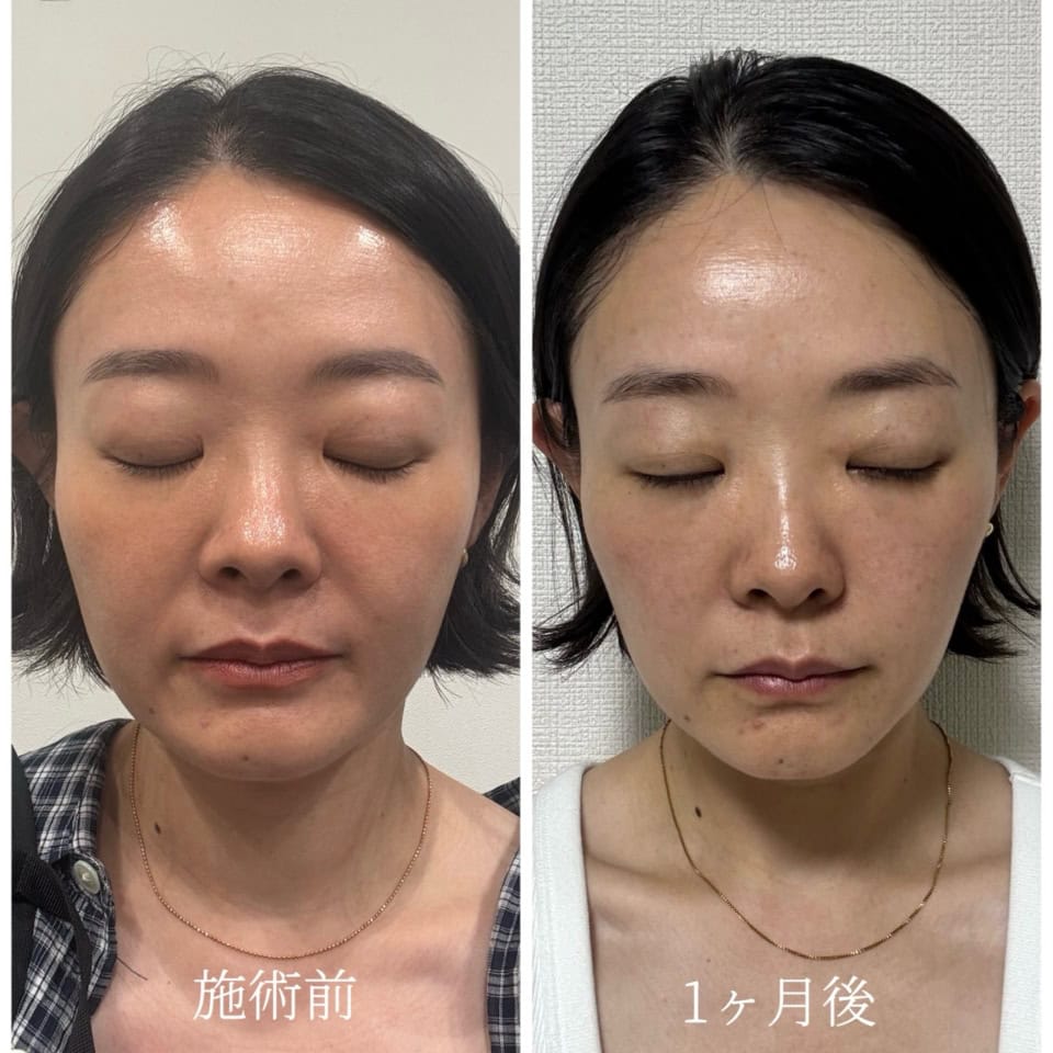 「ダウンタイムほぼなし!」「半永久的!?」韓国人気クリニック【脂肪溶解注射】で驚きの小顔に