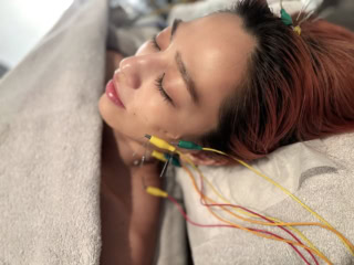 ハリッチの美容鍼