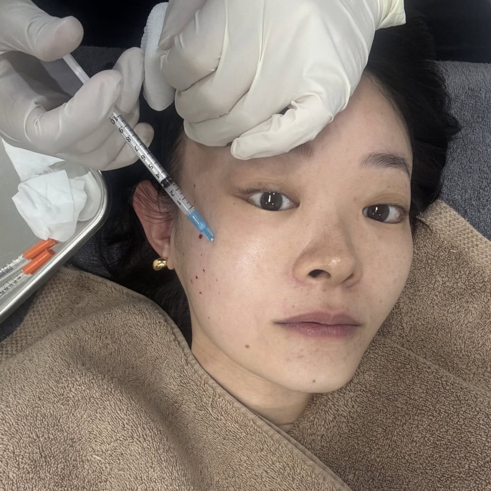 コケやたるみに即効すぎて笑った! 韓国でいちばんホットな施術【Re2O(リトゥオ)】体験レポ