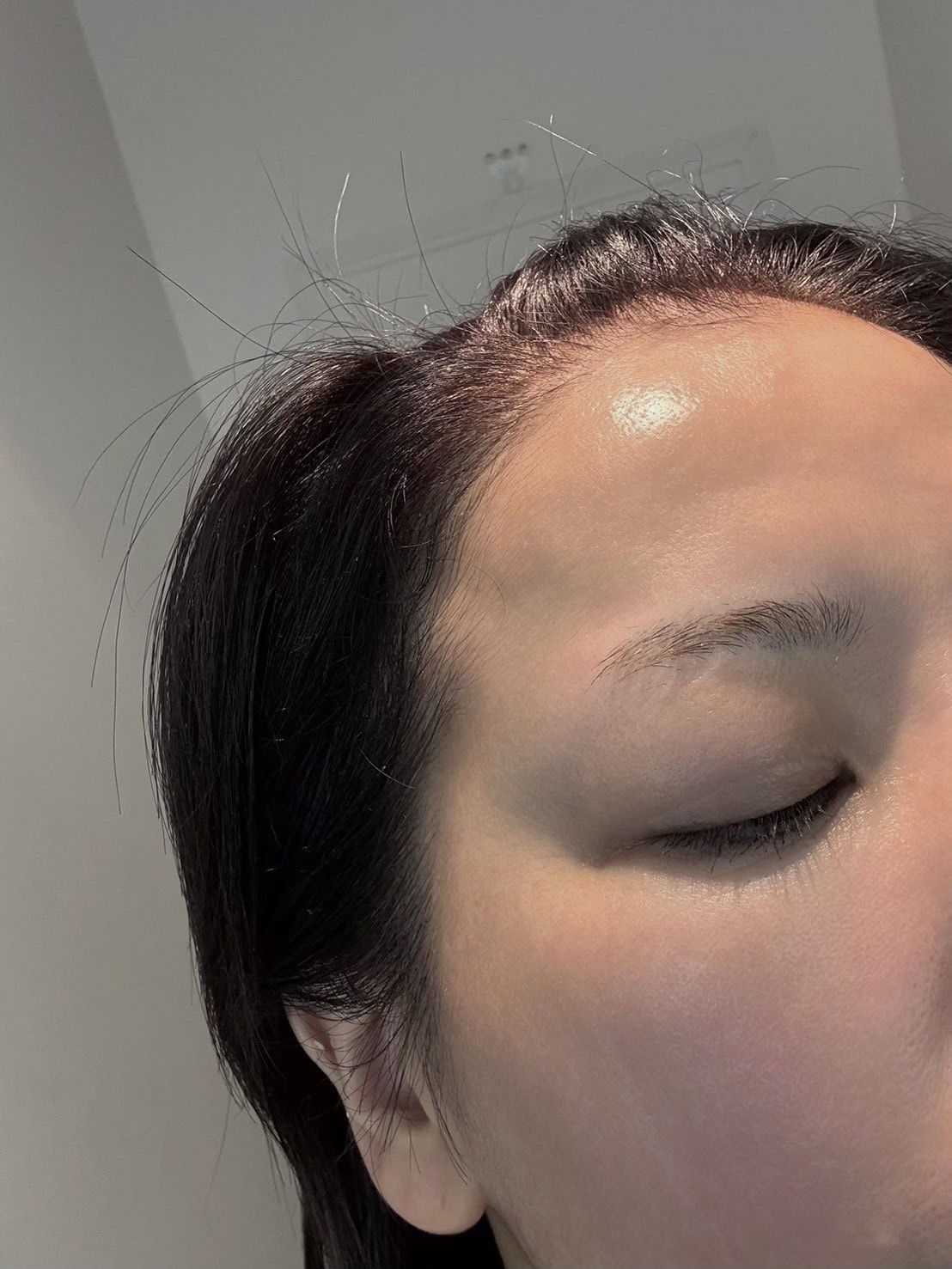 術後の肌。このツヤが全てを証明しています。いつもカサカサと乾燥がちなマット肌に光の玉ができていて感動！