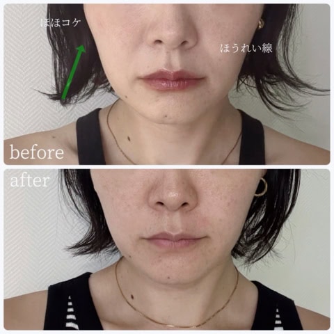 「即効ふっくらで自然！」韓国在住40代美容ライター【最新版】心底やってよかった！美容医療3選