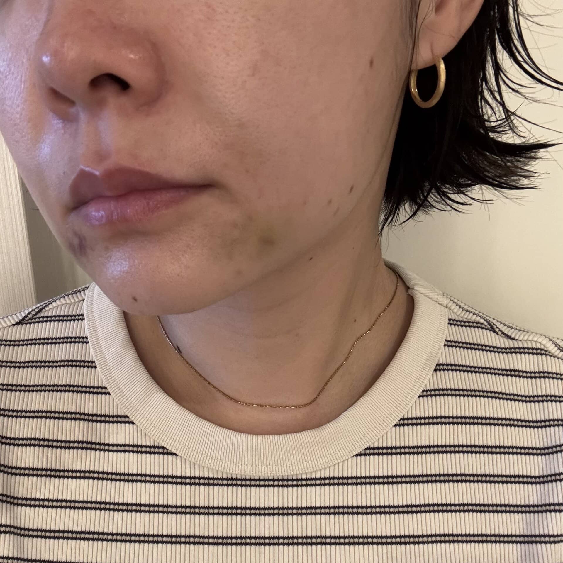 次世代フィラー！？「レディアス」