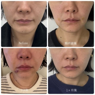 ただし!! 一番気を付けたいのが、“顔が変わってしまう”ダウンタイムがあるということ!!