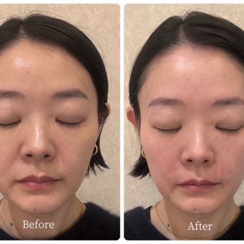 ほうれい線、一体どこいった!? 韓国在住40代ライターが感動【「フィラーの神様」施術レポート】