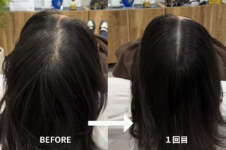 頭皮アートメイクは「1回目で土台を作り、2回目で完成させる」のが基本。ですが、1回目でもこの通り!