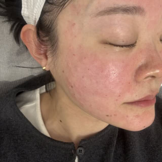 気になる痛みは、どちらもしっかり痛かったです