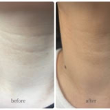 韓国在住ライター二俣愛子の「現地最新リポート」vol.19【首のシワを薄くする施術にトライ】