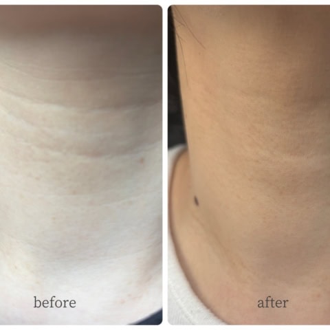 「首がシワシワしてきたね」夫の一言で即予約。韓国在住40代ライター大満足【実録】フィラー施術