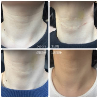 施術前から3週間後、段階別ビフォー＆アフター大公開！　