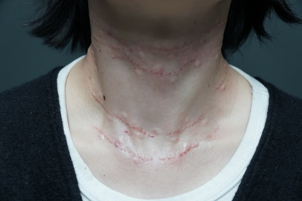 注意！ ダウンタイムは結構長いです