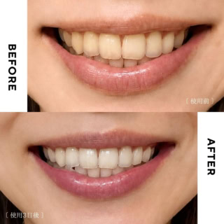毎日洗い上がりが楽しみで、鏡を見て時間をかけてるようになりました!コーヒーや紅茶生活は変わらないので、多少着色は戻ってしまうと思いますが、それでも毎日のケアとしてかなり心強い存在!(※個人差があります)