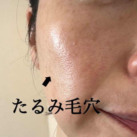 【夏の毛穴決戦】私、諦めないから!ROSY編集長の最強3選で「たるみ毛穴」を制圧