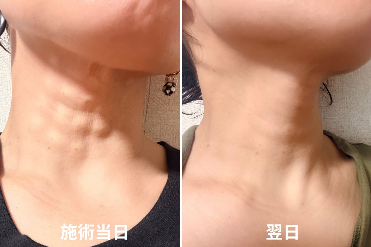 プロファイロ施術後の経過様子。施術当日は注入箇所にポツポツとした小さな隆起（膨らみ）が見られますが、翌日にはすっかり落ち着き、首元がなめらかな状態に戻ります。