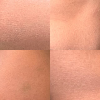 一見するとただのカサつきに見える、リアルな私の全身の肌状態……。実は拡大すると角層がめくれ上がり、白く浮き上がってしまっているんです。これが「粉ふき肌」の正体!バリア機能が低下し、全身の水分が急速に失われているSOSサインです。