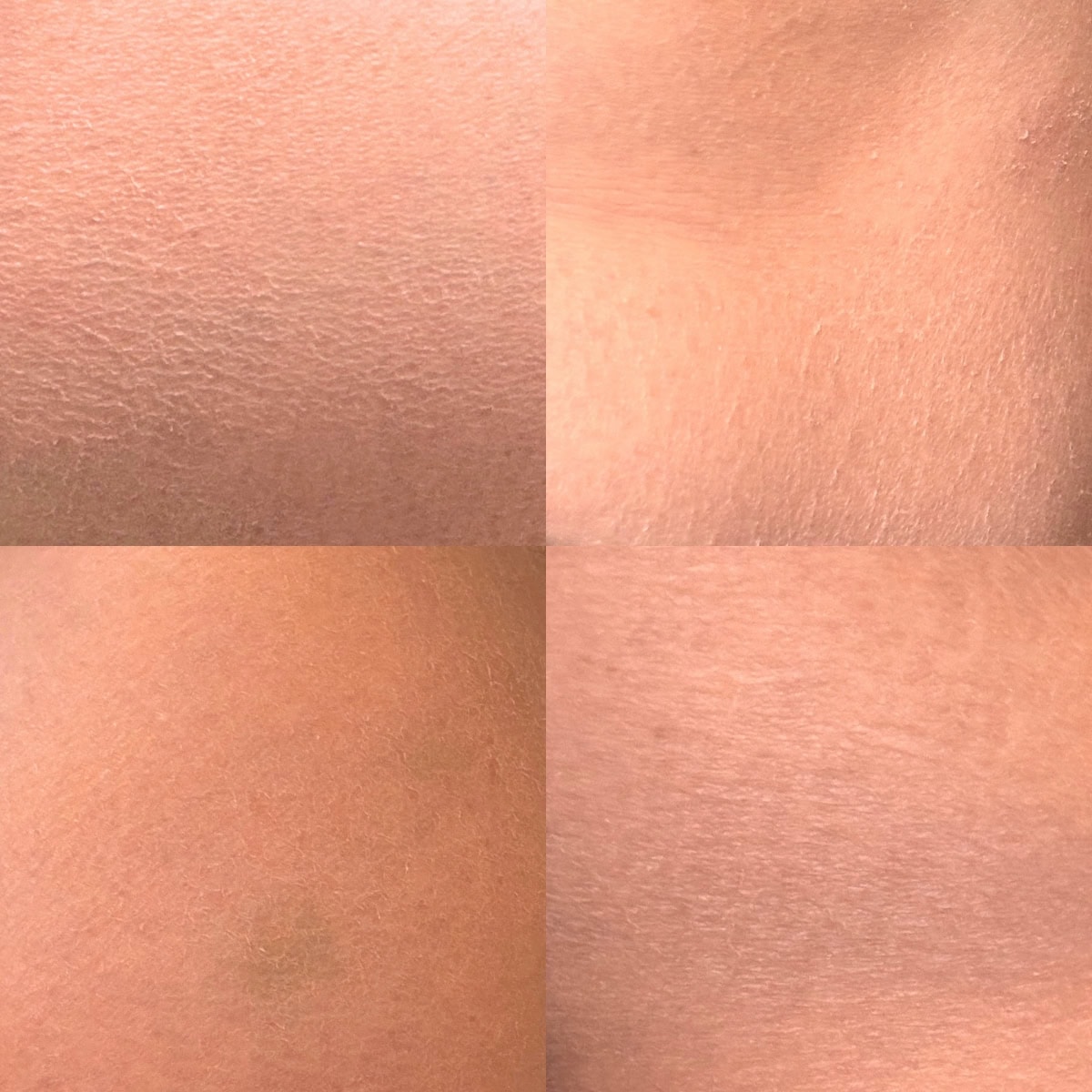 一見するとただのカサつきに見える、リアルな私の全身の肌状態……。実は拡大すると角層がめくれ上がり、白く浮き上がってしまっているんです。これが「粉ふき肌」の正体!バリア機能が低下し、全身の水分が急速に失われているSOSサインです。