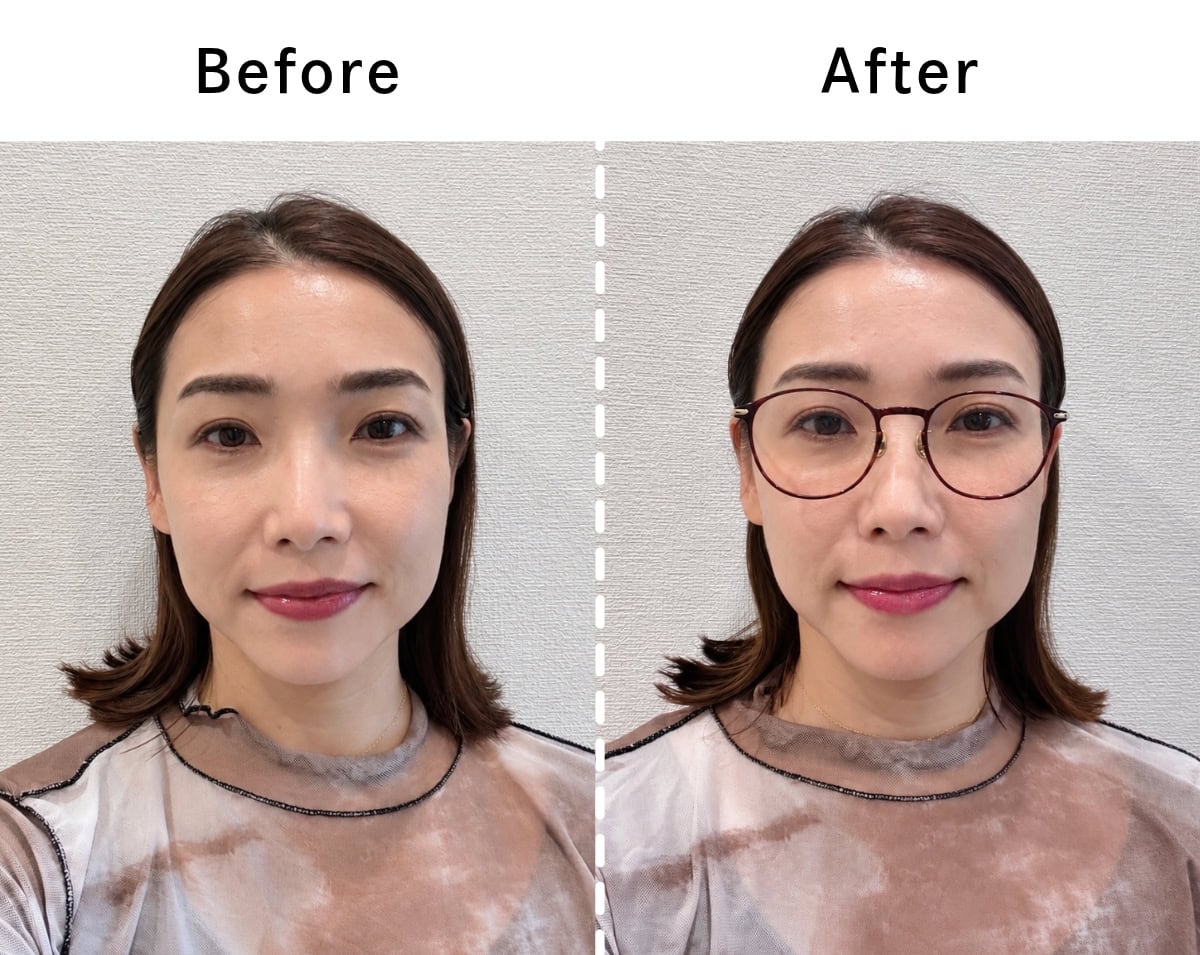 物理的に顔が縮むわけじゃないのに、かけるだけでこの差！Beforeだと、目の下の余白が気になりますが、メガネの縦幅とチークレンズの効果で、頬の余白がキュッと埋まってキュートなバランスに見えるのが分かりますか…!? JINS Combination Titanium ［中顔面短縮メガネ］ 全3色 ¥14,900（ジンズ）